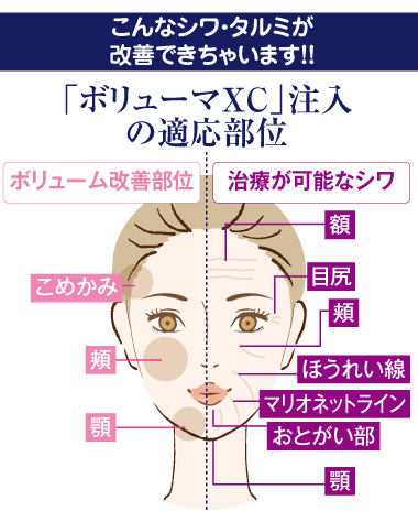 こんなシワ・たるみまで改善できちゃう！治療が可能なシワ：額、目尻、頬、ほうれい線、マリオネットライン、おとがい部、顎。ボリューム改善部位：こめかみ、頬、顎。