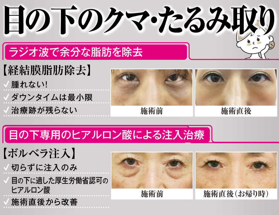 目の下のクマ・たるみ取り[目の下のクマ・たるみ取り][目の下のクマ・たるみ取り]